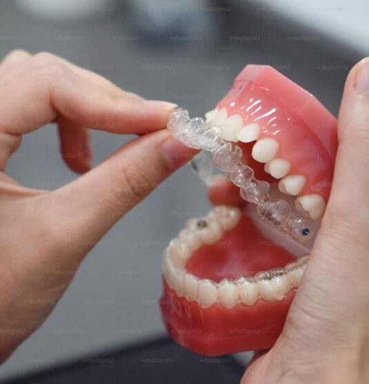 Invisalign clear aligners in Towson MD at Smithberger DDS